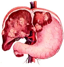 Cancerul hepatic - simptome si tratament